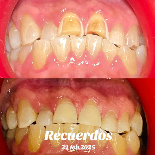 Resultado de carillas dentales de porcelana para diseño de sonrisa en Alfa Dental Care