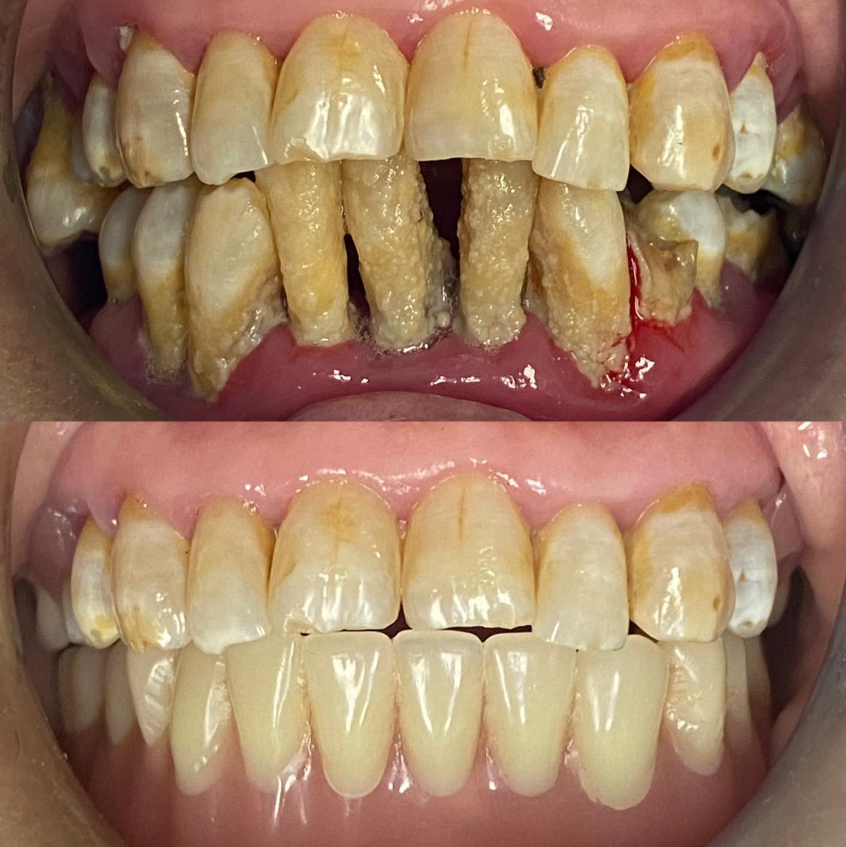 Caso de carillas dentales completas para mejorar la estética de la sonrisa del paciente
