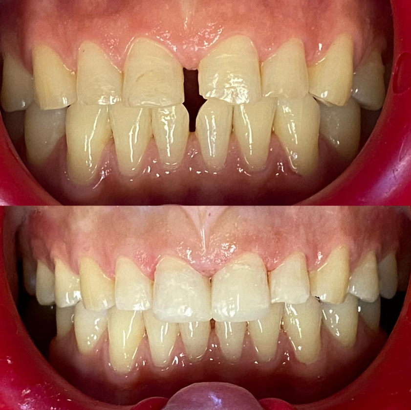 Corrección de diastema dental, cierre de espacio entre dientes con resultados naturales