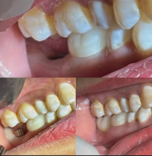 Caso exitoso de implante dental realizado en Alfa Dental Care, antes y después del tratamiento
