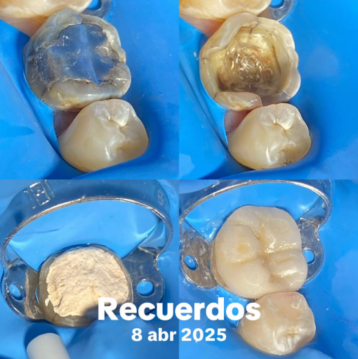Restauración dental con relleno de resina compuesta, resultado estético y funcional