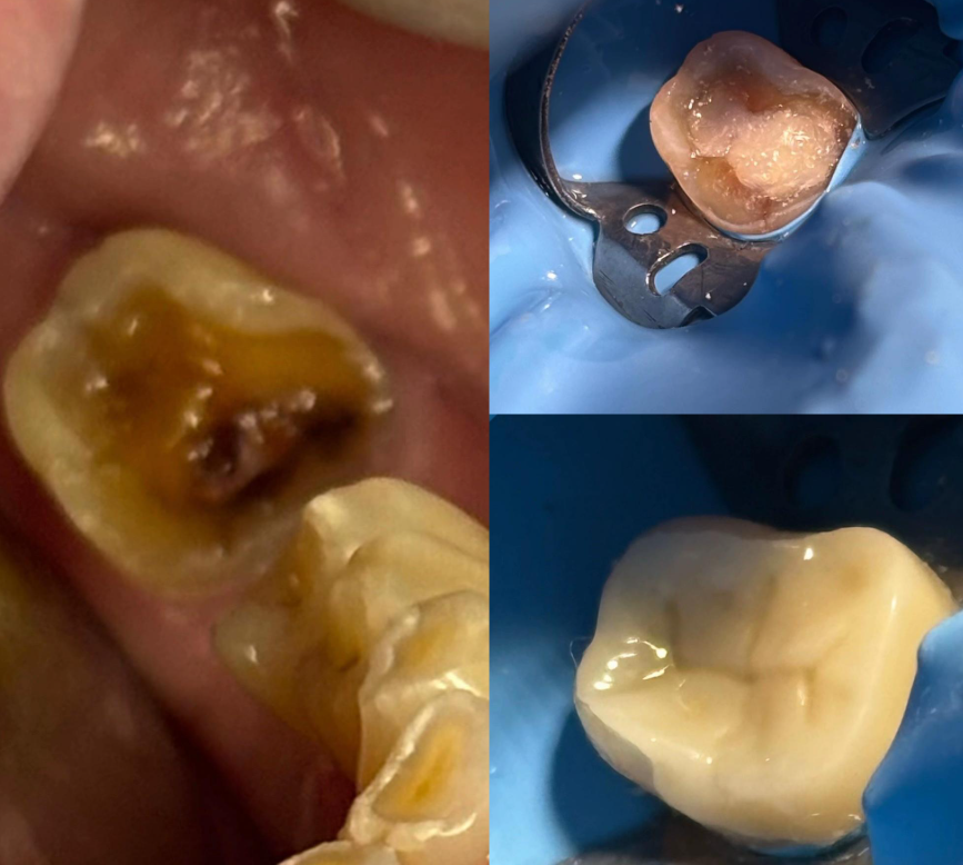 Caso de relleno dental con resina de alta calidad para recuperar la forma natural del diente